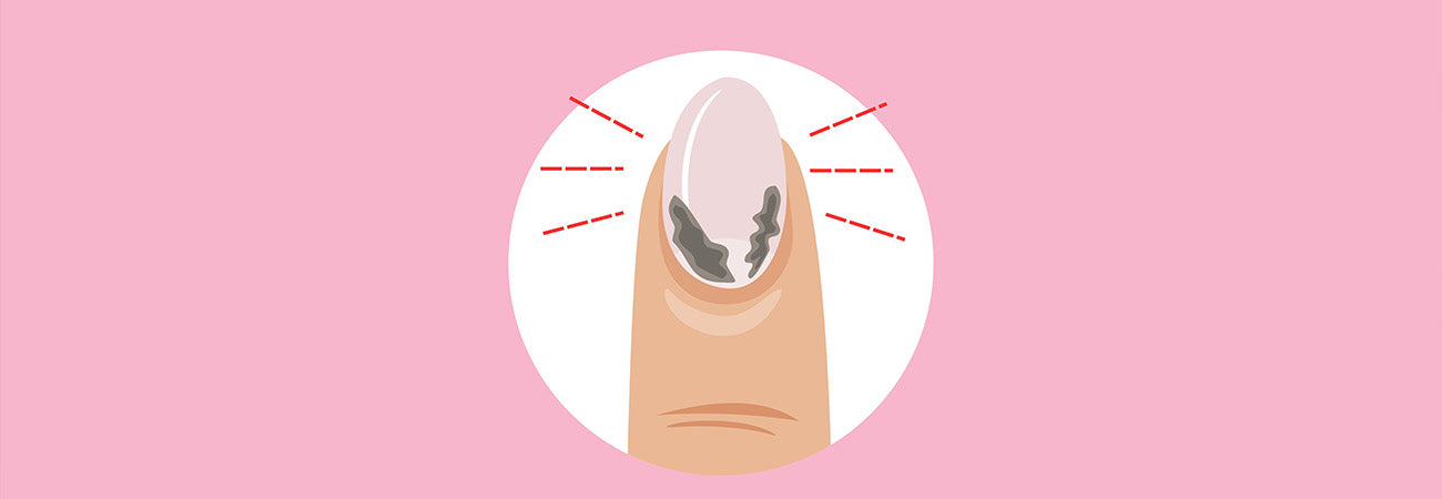 Allergische reactie van nagels? Ontdek de oorzaken, symptomen en voorkom!