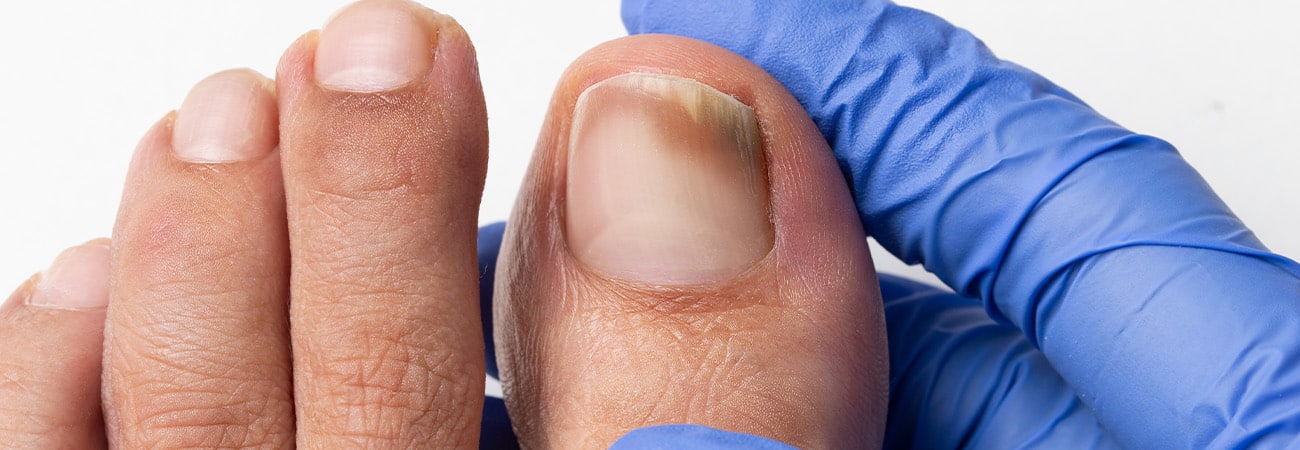 Subunguaal Hematoom: Bloeduitstorting of Blauwe Nagel - Herome Cosmetics