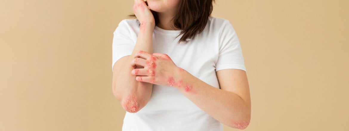 Handeczeem begrijpen: oorzaken, symptomen en effectieve behandelingen