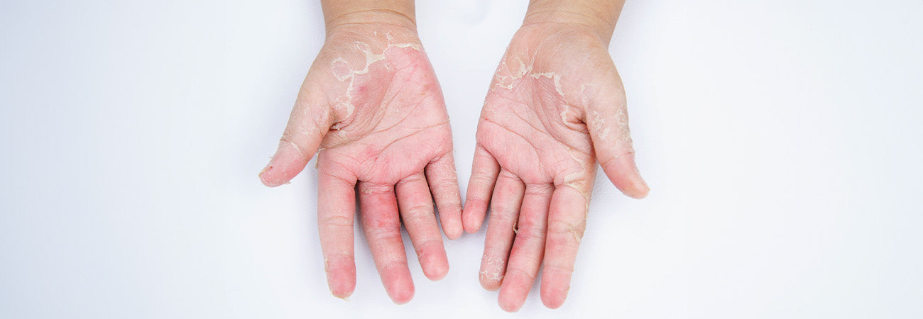 Psoriasis behandeling: welke opties zijn er voor jouw handen?